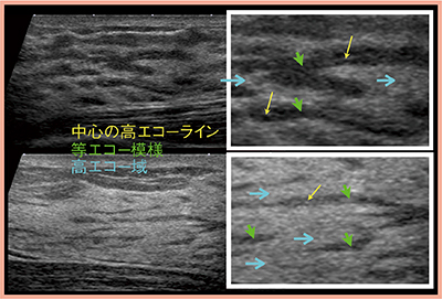 図1　超音波における乳腺の正常構造の描出
