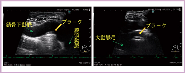 図3　症例2：4G CMUTによる両側鎖骨下動脈起始部の描出（鎖骨下動脈の初期病変：プラーク）
