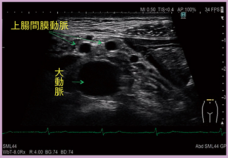 図5　症例3：4G CMUTによる腹部分枝動脈の描出（動脈解離の除外診断）
