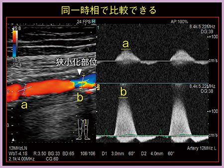 図1　Dual Gate Dopplerを用いた不整脈症例の狭窄病変の血流速度比較