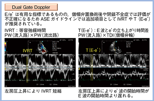 図1　Dual Gate DopplerによるIVRTとT（E-e’）の計測