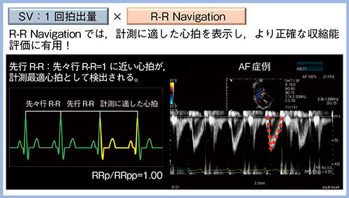 図2　R-R Navigationによるより正確な収縮能評価