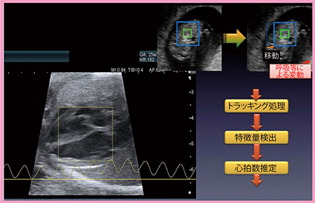 図1　AutoFHRでは胎児心拍数の推定結果を数秒で表示可能