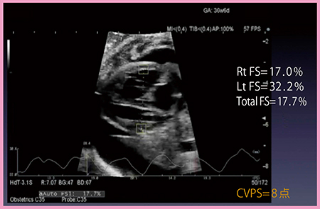 図5　原発性胎児胸水におけるAutoFSの解析結果