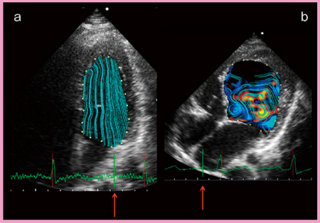 図3　VFMによる正常心（a）と拡張型心筋症（b）の左室流入血流の可視化