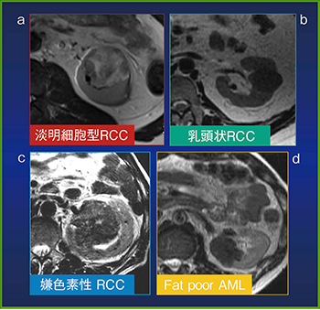 図2　MRIのT2強調画像における腎腫瘤の信号