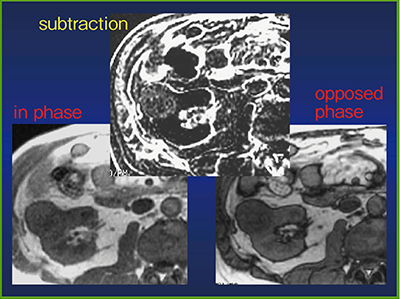 図3　MRIによる細胞内脂肪の描出