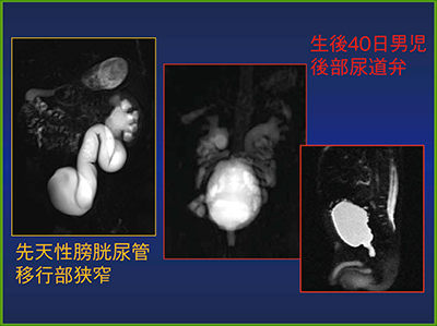図4　新生児の先天性膀胱尿管移行部狭窄のMRU