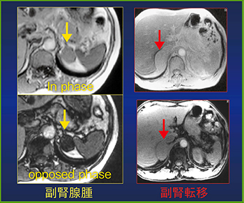 図5　化学シフトMRIでの副腎腺腫と副腎転移の鑑別