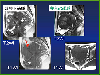 図8　MRIのBridging Vascular Sign
