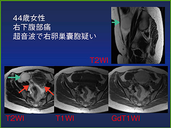 図9　超音波で卵巣囊胞が疑われた虫垂粘液瘤のMRI