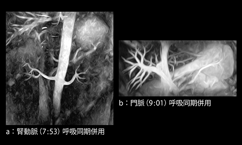 図3　VASC-ASLによる腎動脈，門脈の画像
