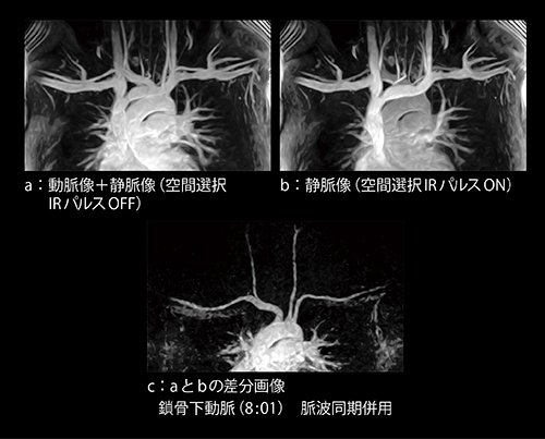 図5　VASC-ASLの差分法における鎖骨下動脈の画像