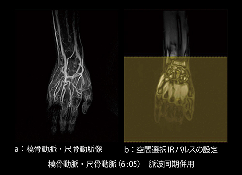図6　VASC-ASLの非差分法における橈骨動脈，尺骨動脈の画像