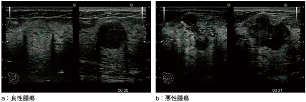 図3　乳腺造影の画像例（画像ご提供：りんくう総合医療センター外科・位藤俊一先生）