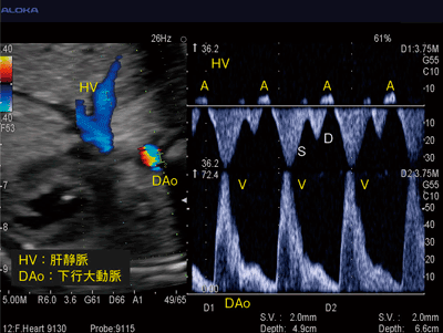 図5　Dual Dopplerによる胎児不整脈の診断
