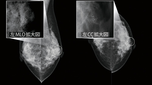 図1　淡く不明瞭な微小石灰化クラスターを有する症例 不均一高濃度乳房で、乳頭付近は乳腺濃度が高くなっている。拡大・濃度調整をしてようやく存在を確認できるような淡く不明瞭な石灰化を検出した。