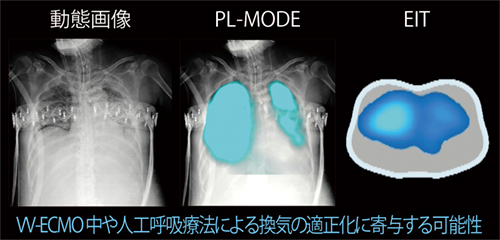 図3　症例2：VV-ECMO中のPL-MODEの画像
