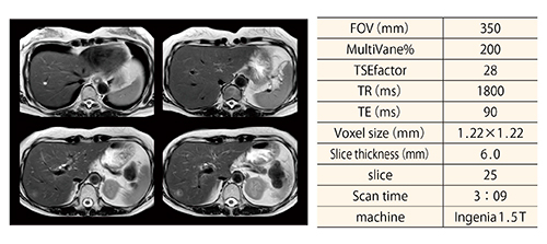 図2　呼吸同期併用T2WI-MV XDの画像