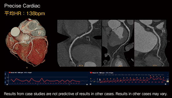 図2　AI画像再構成 Precise Cardiacを用いた高HR症例（HR：138bpm） （画像ご提供：長野中央病院）