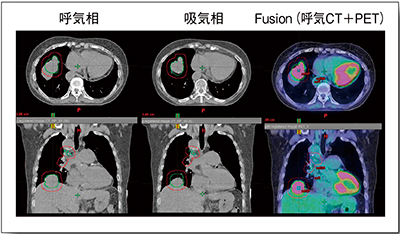図4　症例1：4D-CTから得られる呼気相・吸気相の画像およびPETとのフュージョン画像
