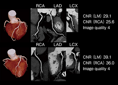 図1　80kVのCoronary CTAの視覚評価 CNRは違うが両方とも良好な画像が得られている。