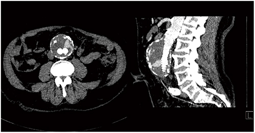 図2　Case2：72歳，大動脈ステントグラフト挿入術後のエンドリーク（70kV，造影剤量12mL）