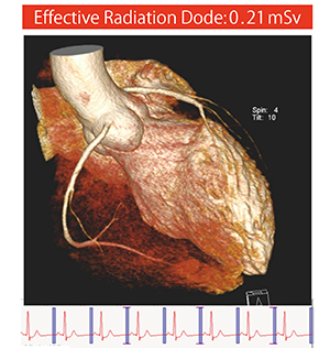 図5　Right Dose Imaging：70kV Retrospective ECG-Gating