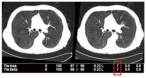 図8　超低線量胸部CTによる閉塞性細気管支炎の鑑別診断（100kV with tin filter →0.098mSv/scan）