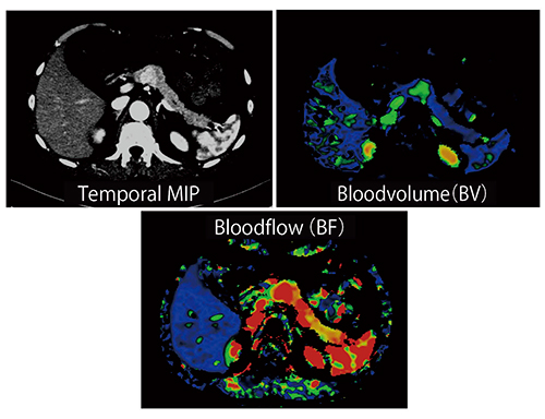 図9　Case5：神経内分泌腫瘍の転移例のDynamic 4D Shuttle Mode Perfusion画像（70kV）
