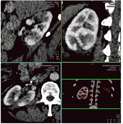 図10　Case6：血管筋脂肪腫の術前4D-CT画像