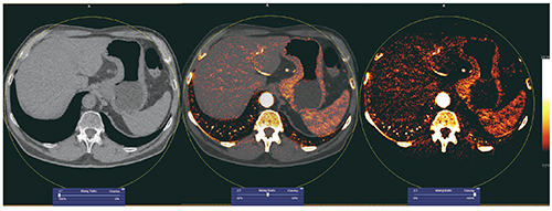 図11　胃がん患者のvirtual non-contrast画像（90/150kV）