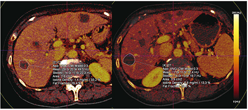 図12　Case7：GIST症例のヨウ素増強画像による腫瘍鑑別評価