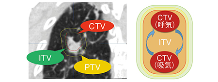 図2　呼吸性移動を考慮したITVの設定