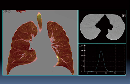 図3　肺換気（Xenon）画像（60歳，男性，非喫煙健常者）