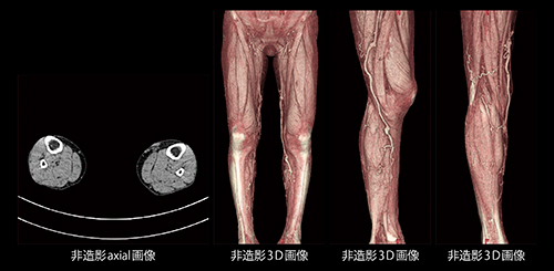 非造影CTにおける下肢表在静脈瘤の描出