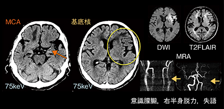図5　症例5：脳梗塞のDECT（左内頸動脈閉塞）