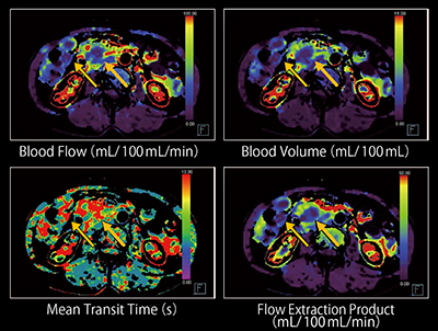 図4　膵頭部がん（70歳代，女性）のパーフュージョンCTのパラメトリック画像