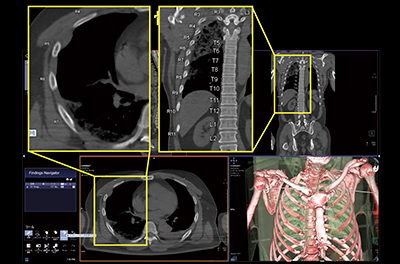 図5　CT Bone Readingの自動ナンバリングと自動作成のVR画像