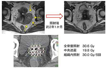 図3　症例1：非対称性のⅢb期の子宮頸がん（扁平上皮癌）
