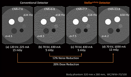 図2　Vectron＋StellarInfinity Detectorによるノイズと被ばく線量の低減