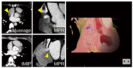 図5　症例4：心房中隔欠損症の“Time-blended”CTを用いた術前プランニング画像