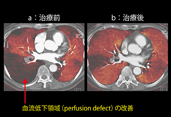 図6　症例6：肺塞栓のDE Lung PBV（77歳，女性）