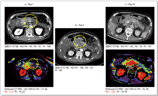 図2　症例1：造影CTとWhole Pancreatic Perfusion CT所見