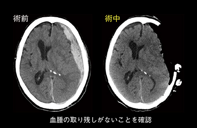 図4　脳神経外科における急性硬膜下血腫の術中CT画像