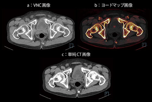 図7　症例7：膀胱がん（ヨードマップ画像）
