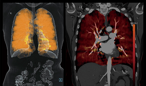 図9　症例9：肺がん（DE Lung PBV画像）