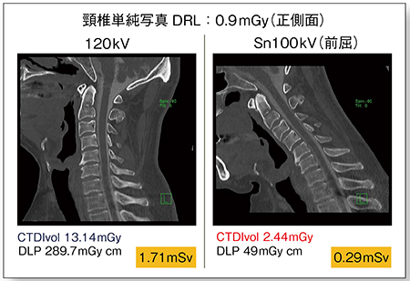 図4　超低線量CTによる頸椎のキネティックCT myelography