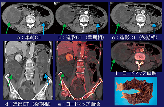 図3　症例3：ヨードマップ画像による絞扼性腸閉塞の虚血の評価