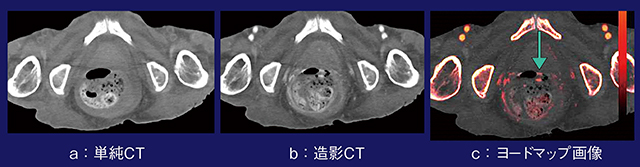 図5　症例5：ヨードマップ画像による腸管内の便と造影剤の鑑別